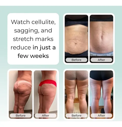 Crema Antiarrugas Para Estrías Sculpiflex