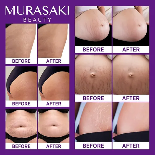 Crema Antiestrías Embarazo Murasaki 120g Nutre Y Previene