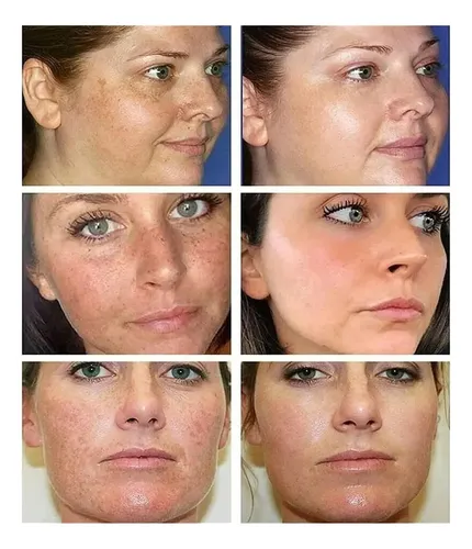 Crema Facial Despigmentante Para Manchas Oscuras Todo -{