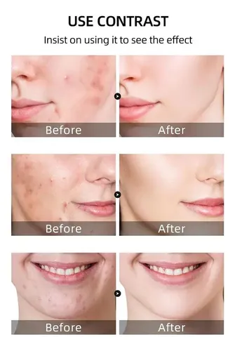 Crema Facial Para Acné,reduce Granos Y Manchas,hidratante