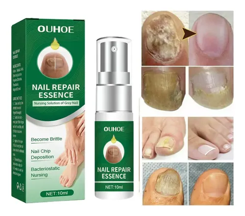 Suero Reparacion Uñas Ataca Hongos Onicomicosis Pies Manos