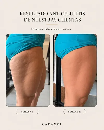 Aceite De Masaje Reafirmante Anticelulitis (oferta) X3