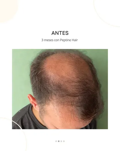 Peptine Hair Peptona Caída Cabello Bio-regenerador Capilar