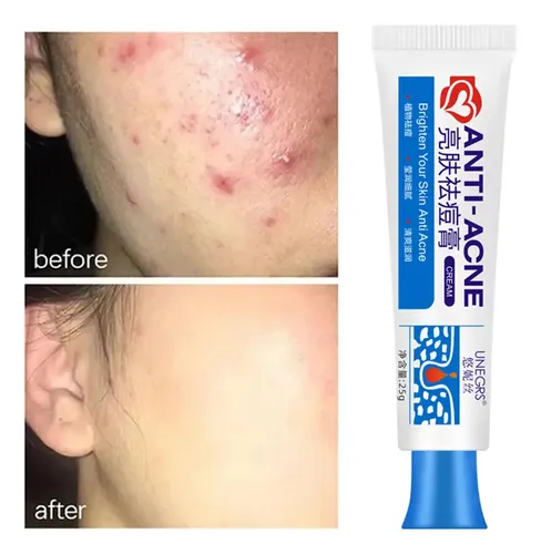 Crema De Tratamiento Antiacné Con Ácido Salicílico Para El A