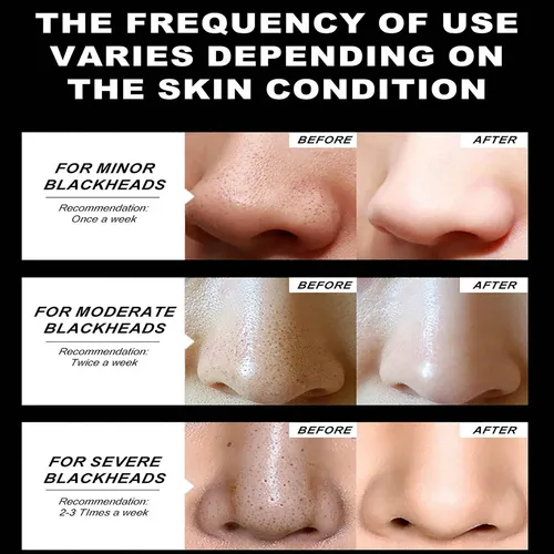 Mascarilla Nasal Exfoliante Para Eliminar Puntos Negros, 50