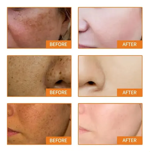 Special Offer T; Crema Correctora De Manchas Oscuras ..