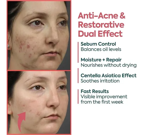 Crema Acne Facial 40 Ml Her Kozmetik Faceupskin