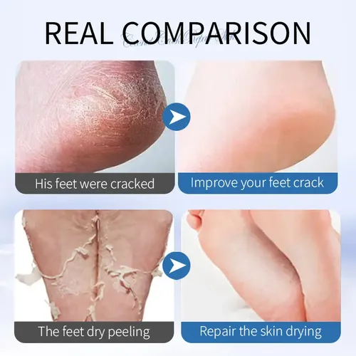 Crema Hidratante Reparadora De Grietas En Los Pies