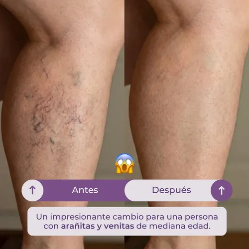 Crema Para Varices Arañitas Piernas Aureva Varisens 50ml