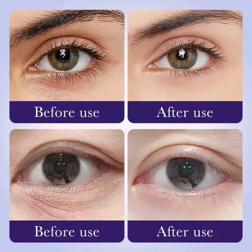 Contorno Ojos Ácido Hialurónico Antiarrugas Sadoer