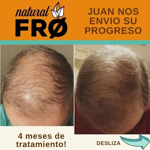 Locion Capilar Naturalfro Caida X 100ml + Shampoo Solido Kit