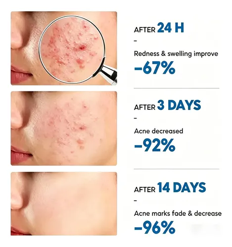 Gel Antiacné Reparador Calmante Hidratante 30 G Todo Tipo De Piel Día/noche