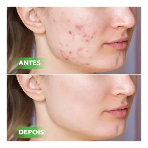 Crema De Ácido Salicílico Aa X Z Para Remoción De Poros Acné