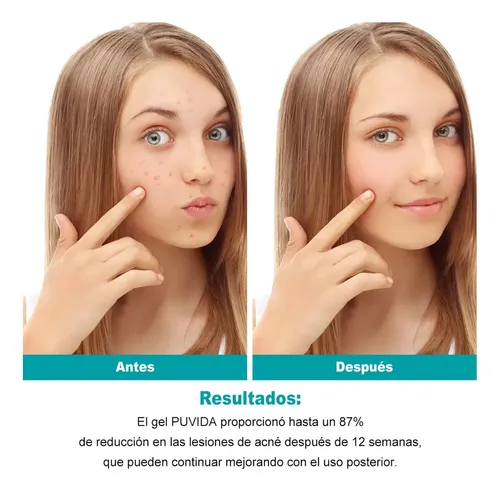 Creme Para Acne Trata A Acne No Rosto E No Corpo