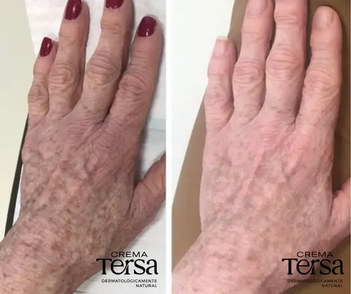 Mzcrema Tersa Despigmentante Quita Manchas Acné Paño De 40gm