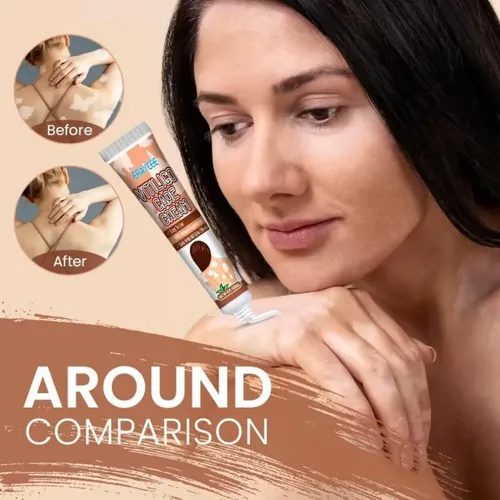 M* Crema Para El Vitíligo Para Reducir Las Manchas *xl