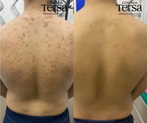Mzcrema Tersa Despigmentante Quita Manchas Acné Paño De 40gm