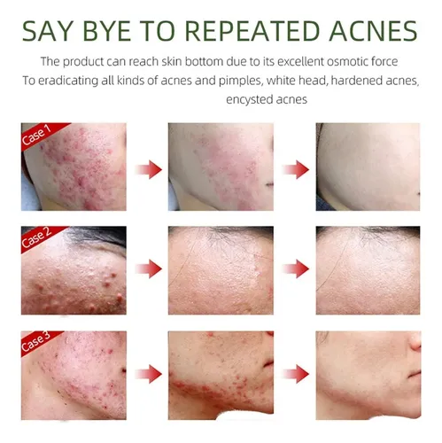 Crema Facial For Eliminar El Acné, Crema Hidratante