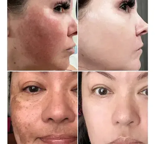 Crema Blanqueadora De Melasma Para Una Eliminación Eficaz