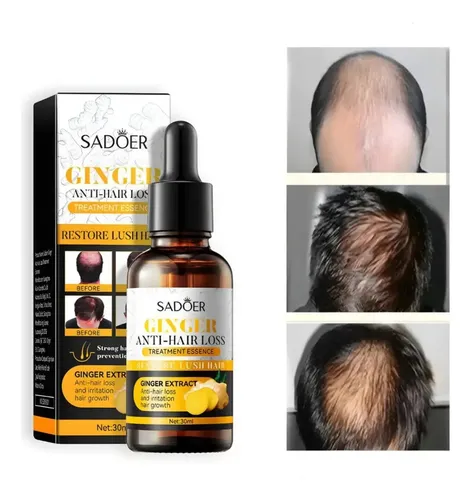 Sérum Concentrado De Jengibre Para El Crecimiento Del Cabell