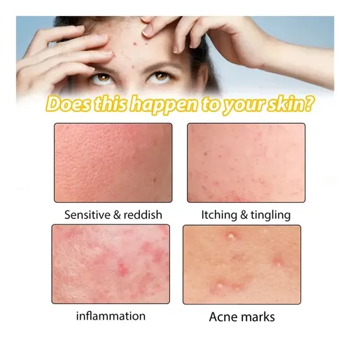 2×crema Para Tratar El Acné Combate El Acné Quístico Hormon Todo Tipo De Piel