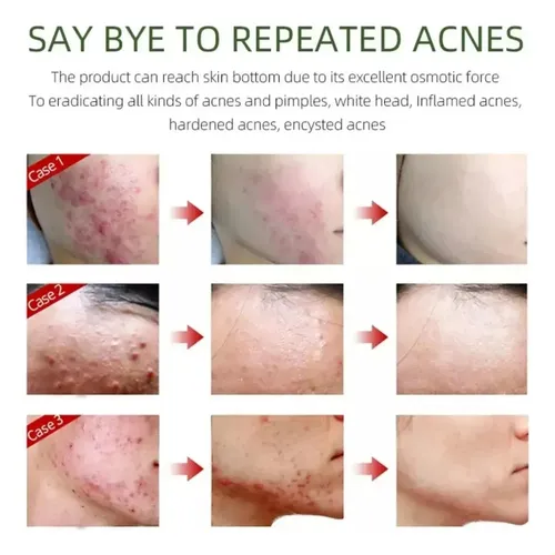 Crema Antiacné, Elimina Profesionalmente Las