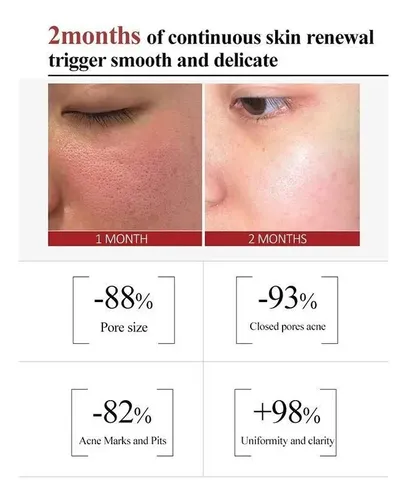 Crema Facial Con Ácido Salicílico 20ml Para Poros
