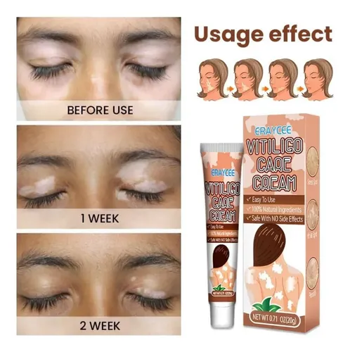 M* Crema Para El Vitíligo Para Reducir Las Manchas *xl
