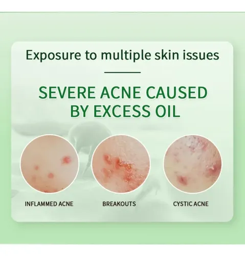 Crema Para El Cuidado Del Acné De 15 Ml, Máscara De Arcilla