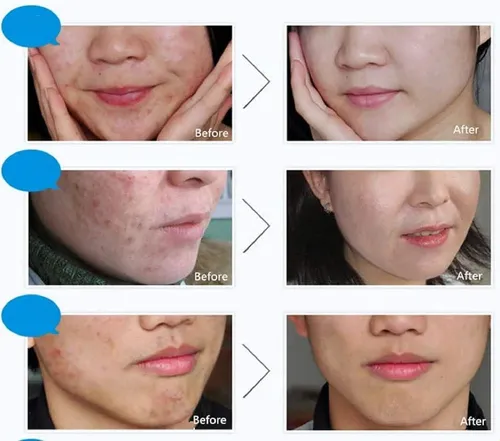 Crema Antiarrugas Para Eliminar Manchas Para El Acné Y La Pi