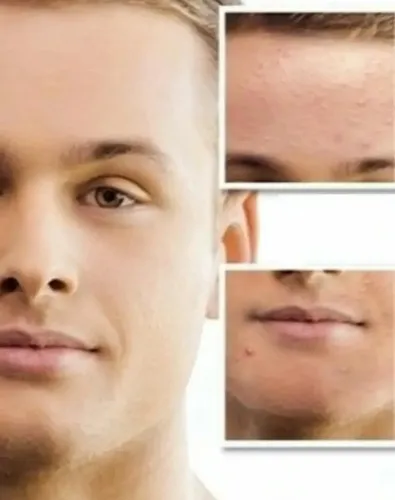 Sebum Control Tratamiento P/ Piel Grasa Elimina Sebo Y Acne