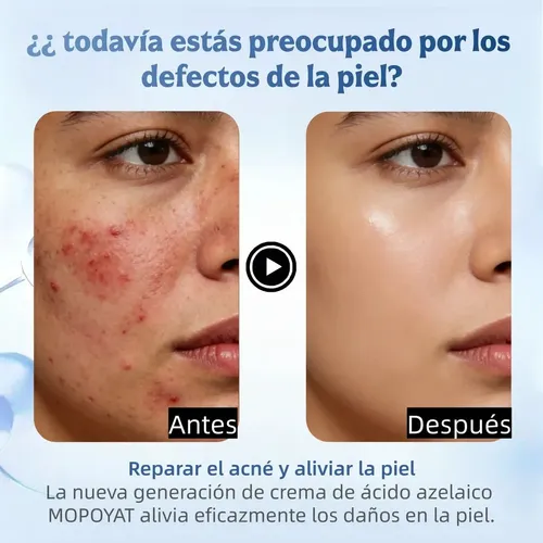 Cc///crema De Ácido Azelaico 20 /acné Y Tono Opaco//dd