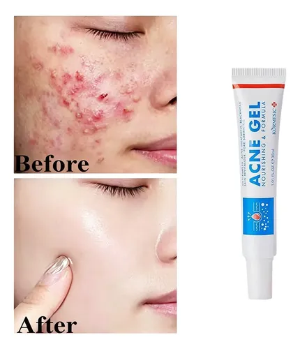 Gel Antiacné Reparador Calmante Hidratante 30 G Todo Tipo De Piel Día/noche