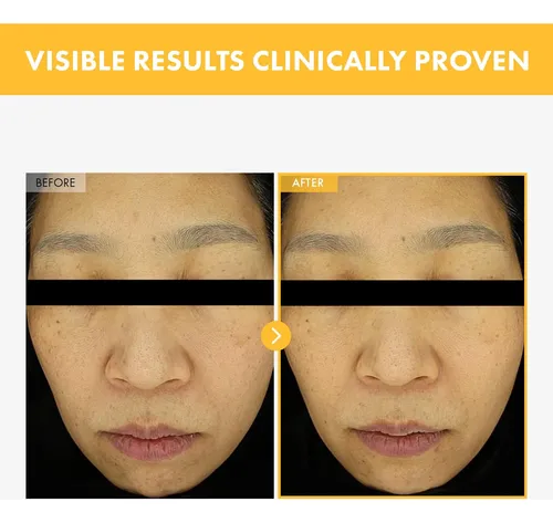 8 Days Spot Cream, Dark Spot Remover For Face, Age Spot,