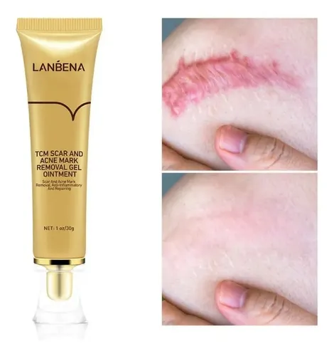 Lanbena Gel, Cicatrices ,manchas Estrías Seca Brotes De Acne Tipo De Piel Mixta Seca Y Grasa