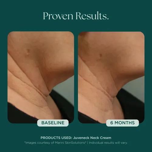 Crema Para El Uello Juveneck De Marini Skin Solutions