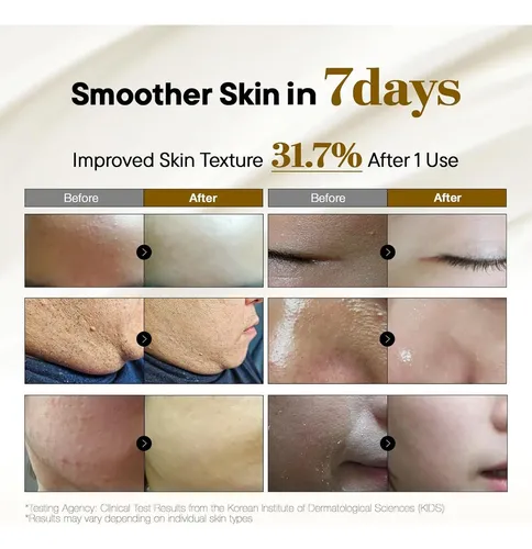 Crema Para Comedones Y Acné Soonyuul Con Niacinamida