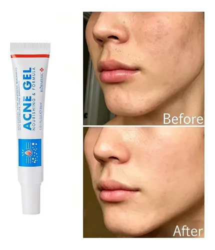 Gel Antiacné Reparador Calmante Hidratante 30 G Todo Tipo De Piel Día/noche