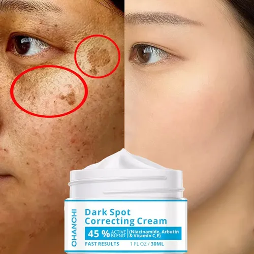 M* Crema Despigmentante Para Manchas, Vitíligo, Acné Y *xl