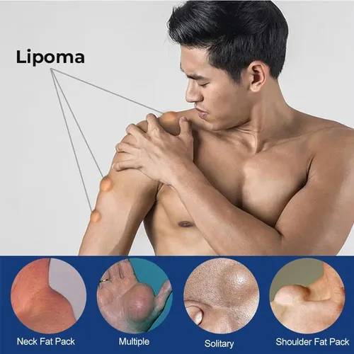 Crema Eliminación De Lipomas 20g2 Unidades –