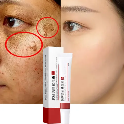 Crema Para Eliminar Pecas Y Melasma Para Manchas Oscuras Ym