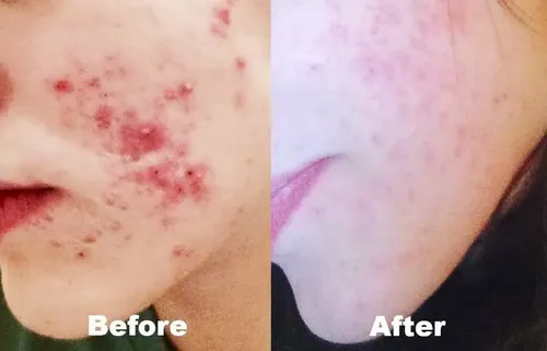 Sebum Control Tratamiento P/ Piel Grasa Elimina Sebo Y Acne