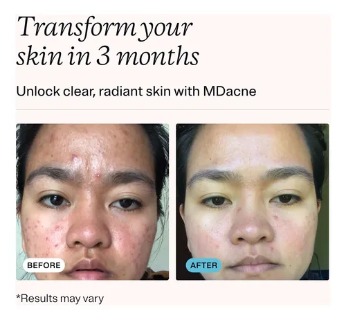 Crema Para El Tratamiento Del Acné Mdacne Con Peróxido De Be