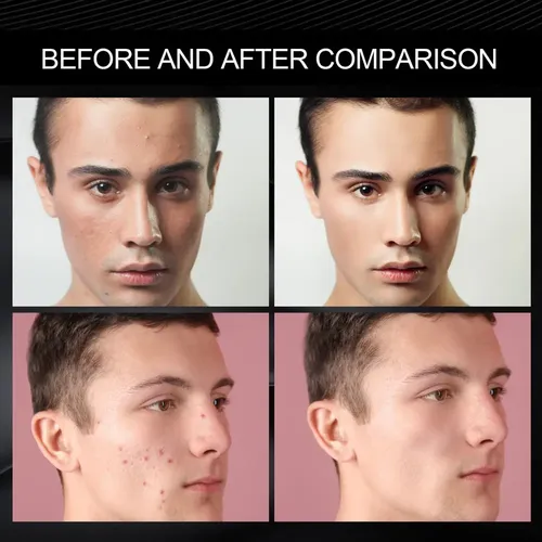 Crema Correctora Para Marcas De Acné Y Defectos