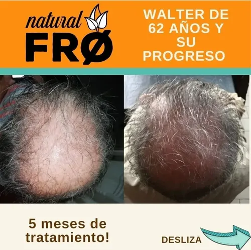 Loción Capilar Crecimiento Alopecia Calvicie Caida X 200ml