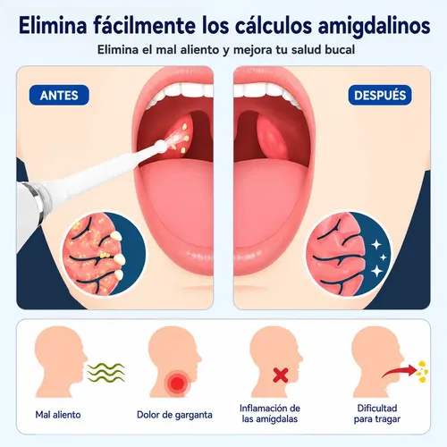 Removedor Aspirador De Caseum calculos Piedras En Las Amígdalas 3 Modos De Intensidad USB Recargable Luz LED Jeringa Espejo 3 Puntas
