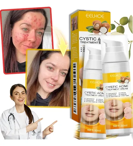 2×crema Para Tratar El Acné Combate El Acné Quístico Hormon Todo Tipo De Piel