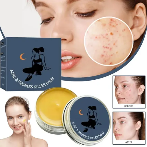 Bálsamo Para El Cuidado De La Piel Facial, Acné Y Enrojecimi