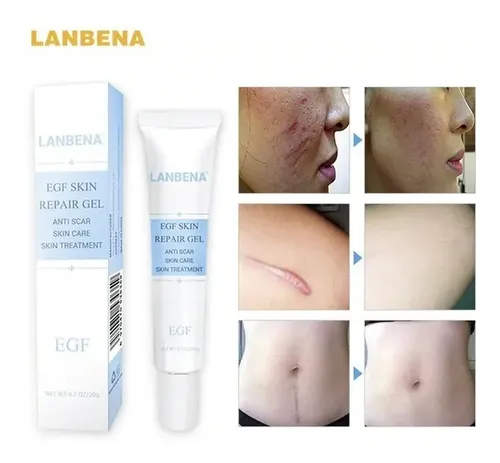Crema Facial Blanqueador Acne Cicatriz No Cicatricure Import