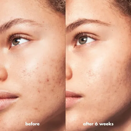 E.l.f. Skin Crema Hidratante Calmante Antiimperfecciones Acneica